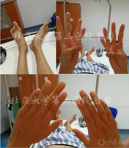 马凡综合征性脊柱畸形:如何获得满意的手术效果?