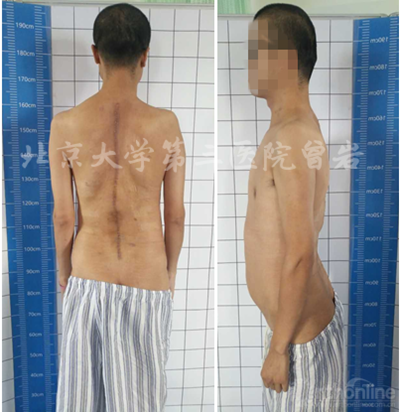 马凡综合征性脊柱畸形:如何获得满意的手术效果?