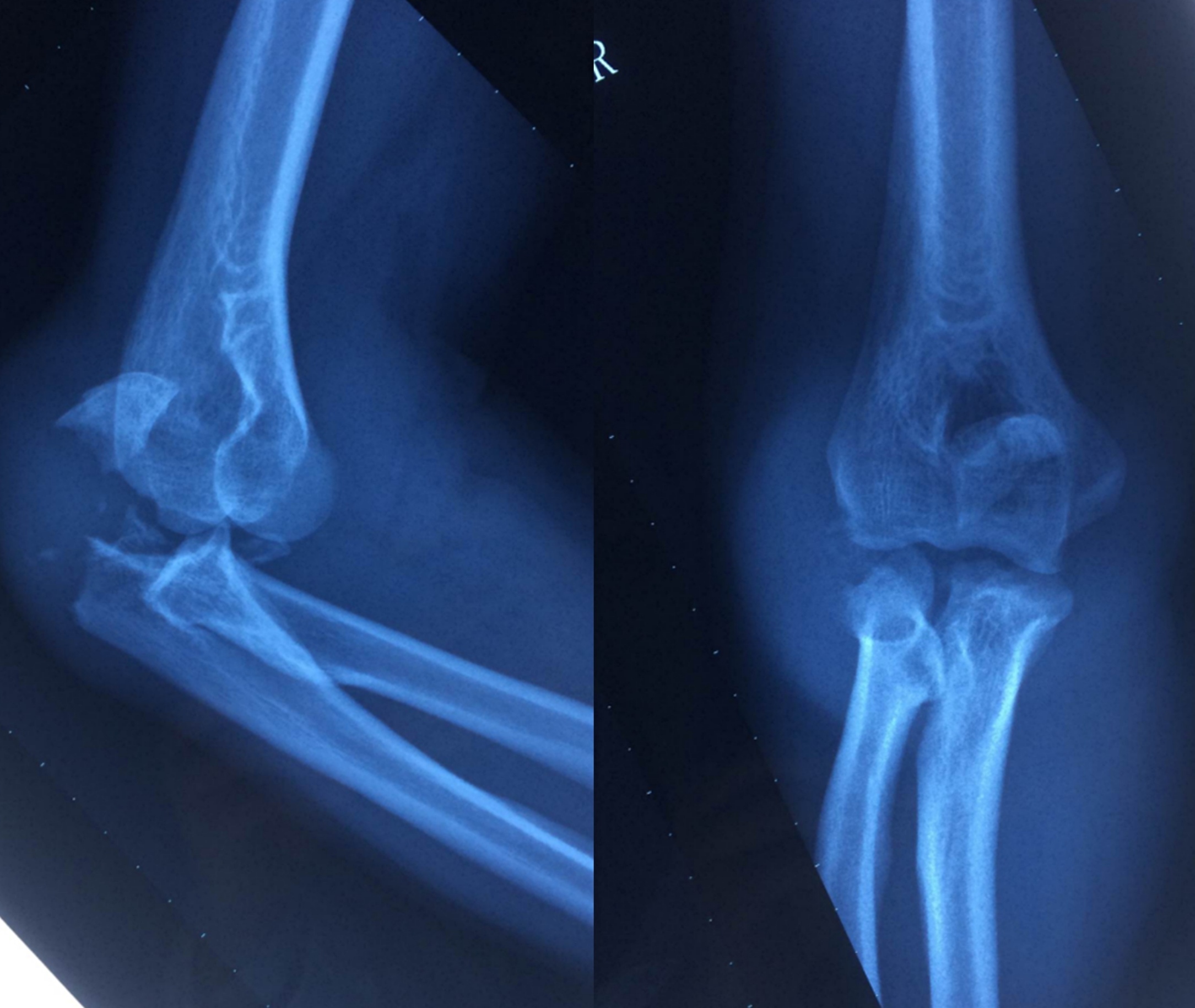 肘关节正侧位正常x线解剖 - 知乎