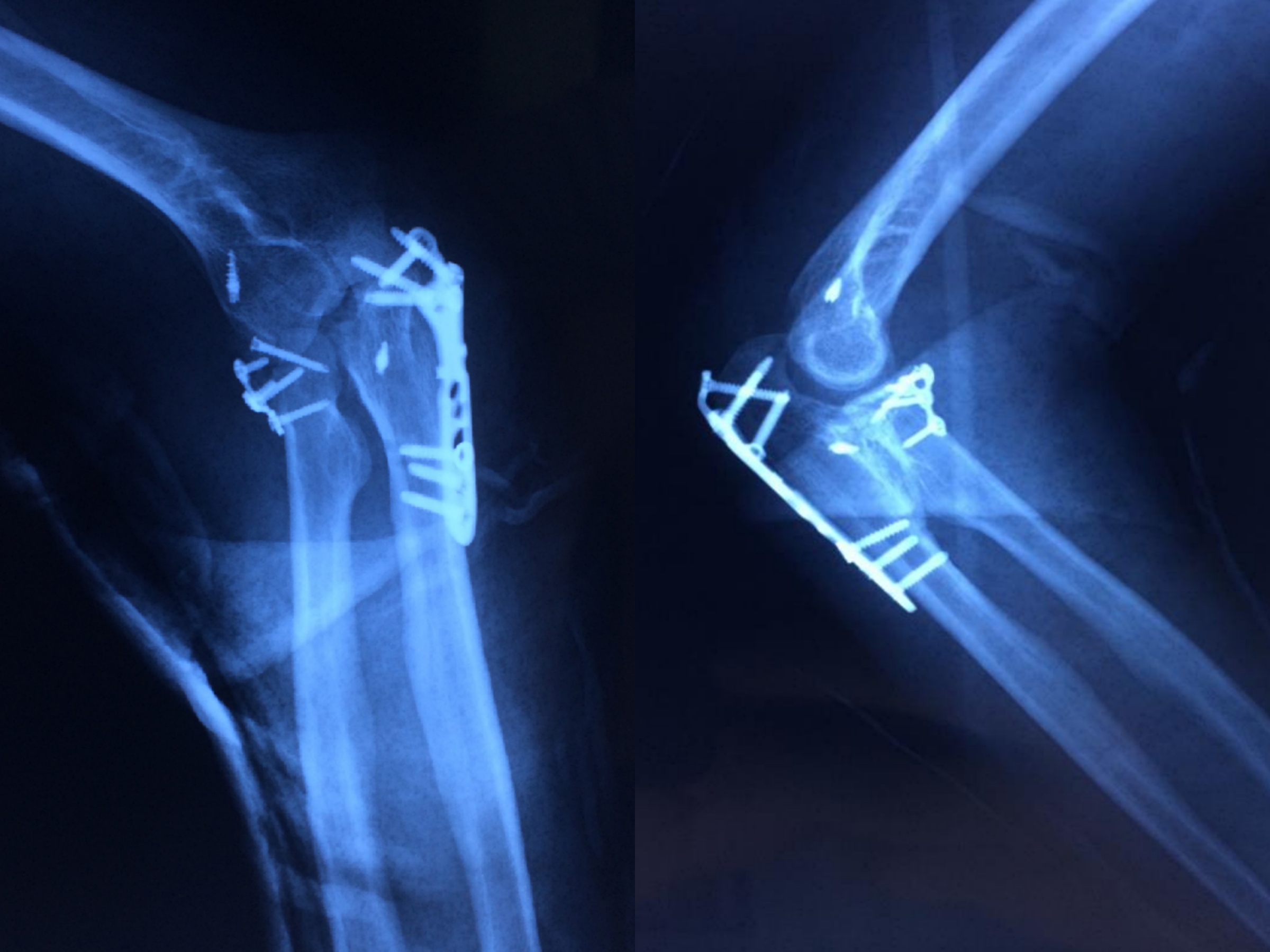鹰嘴截骨入路人工全肘关节置换术的疗效研究|肱三头肌|肘关节|尺神经|关节炎|鹰嘴|截骨|-健康界