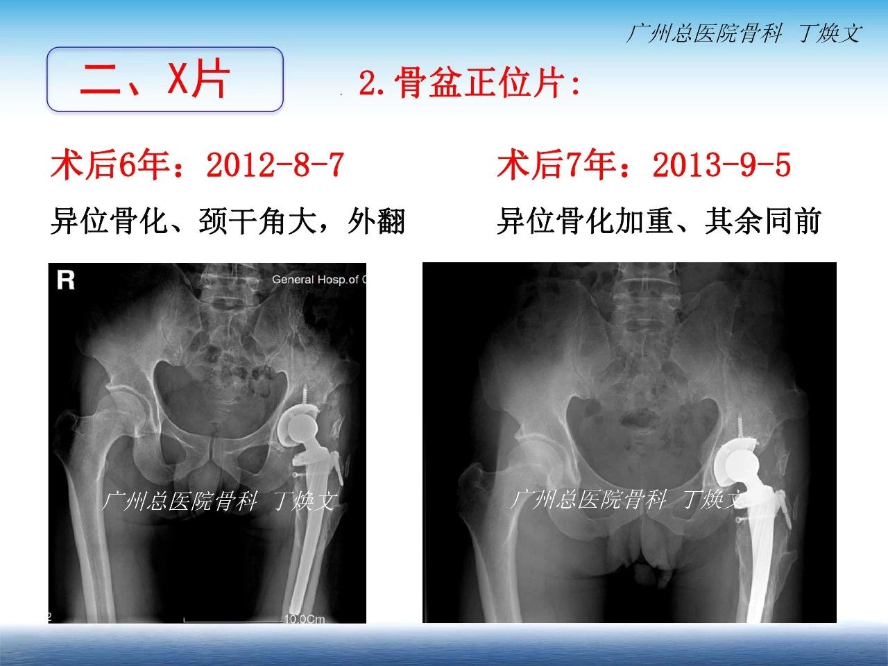 髋关节脱位x光图片-图库-五毛网